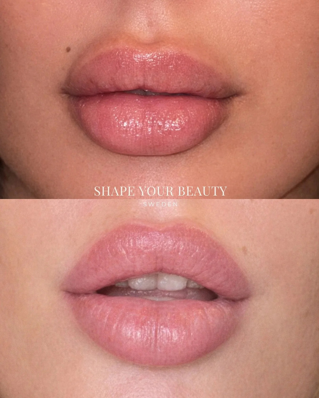 Min kund har gjort fillers i cirka 10 &aring;r (hos andra behandlare) och upplevde med tiden att l&auml;pparna blivit oj&auml;mna, att materialet migrerat och att sm&aring; klumpar bildats.

Vi valde d&auml;rf&ouml;r att l&auml;gga upp en l&aring;ngs