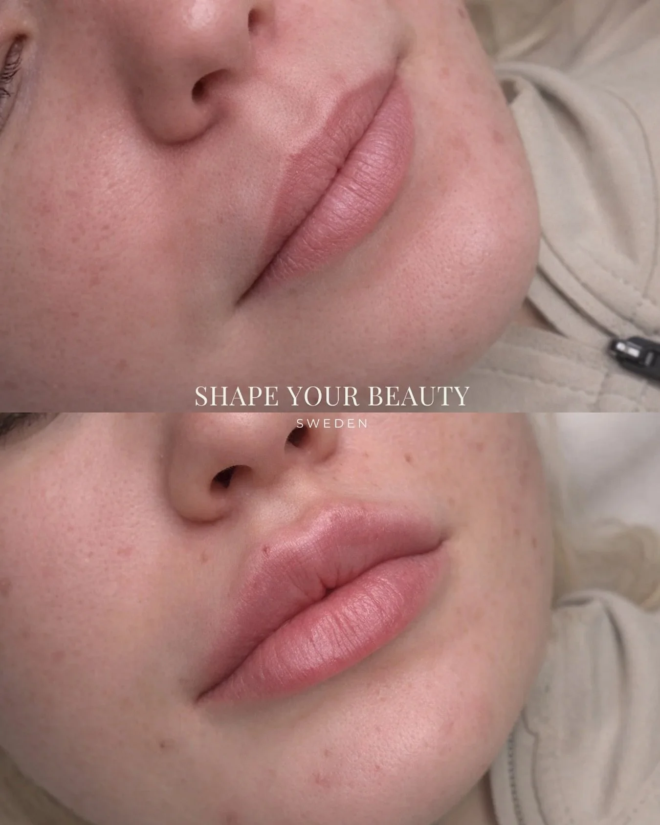 1 ml Russian 😍 Naturligt men med wow-effekt! Volym + fyllighet + form = fulltr&auml;ff.