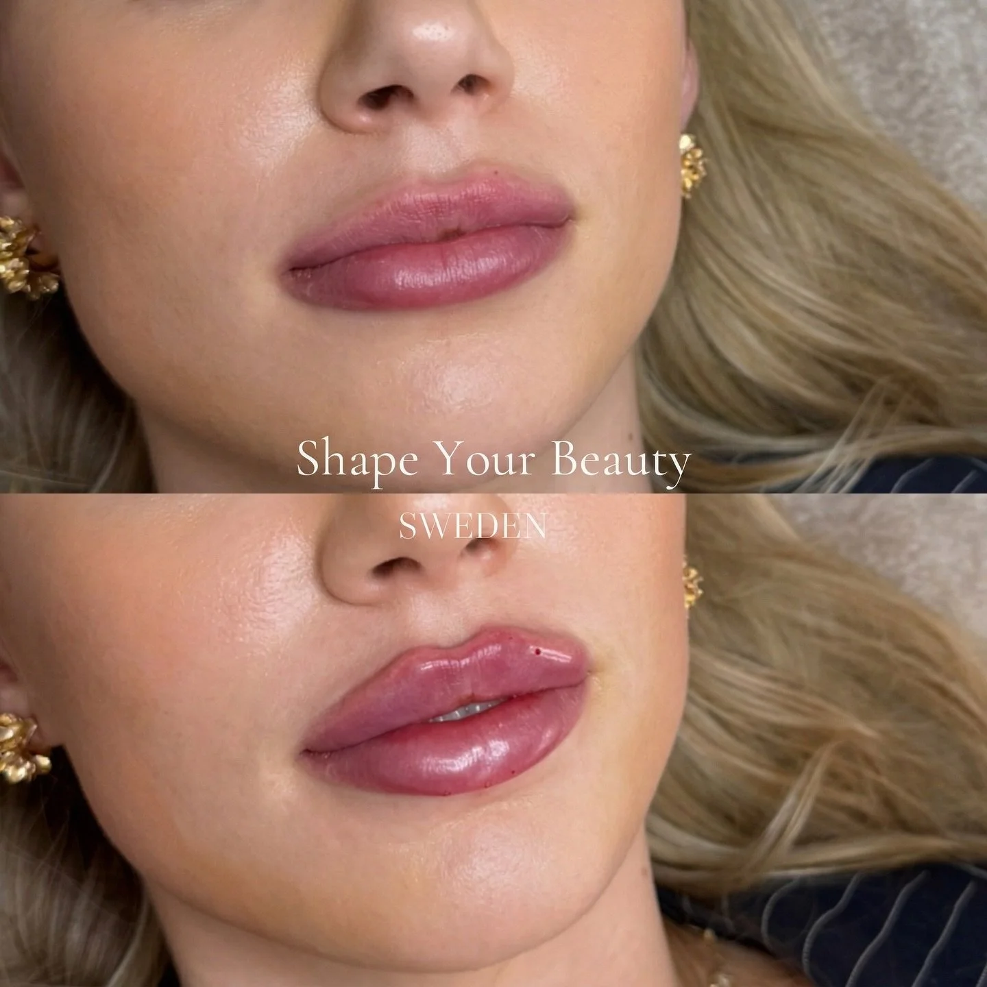 ELEGANS &amp; SYMMETRI
En touch up p&aring; dessa fina l&auml;ppar som tidigare behandlats hos annan klinik. Endast 0,5ml Russian lips med fokus p&aring; &ouml;verl&auml;pp🤍 ni hittar oss i Stockholm och &Ouml;stersund📍