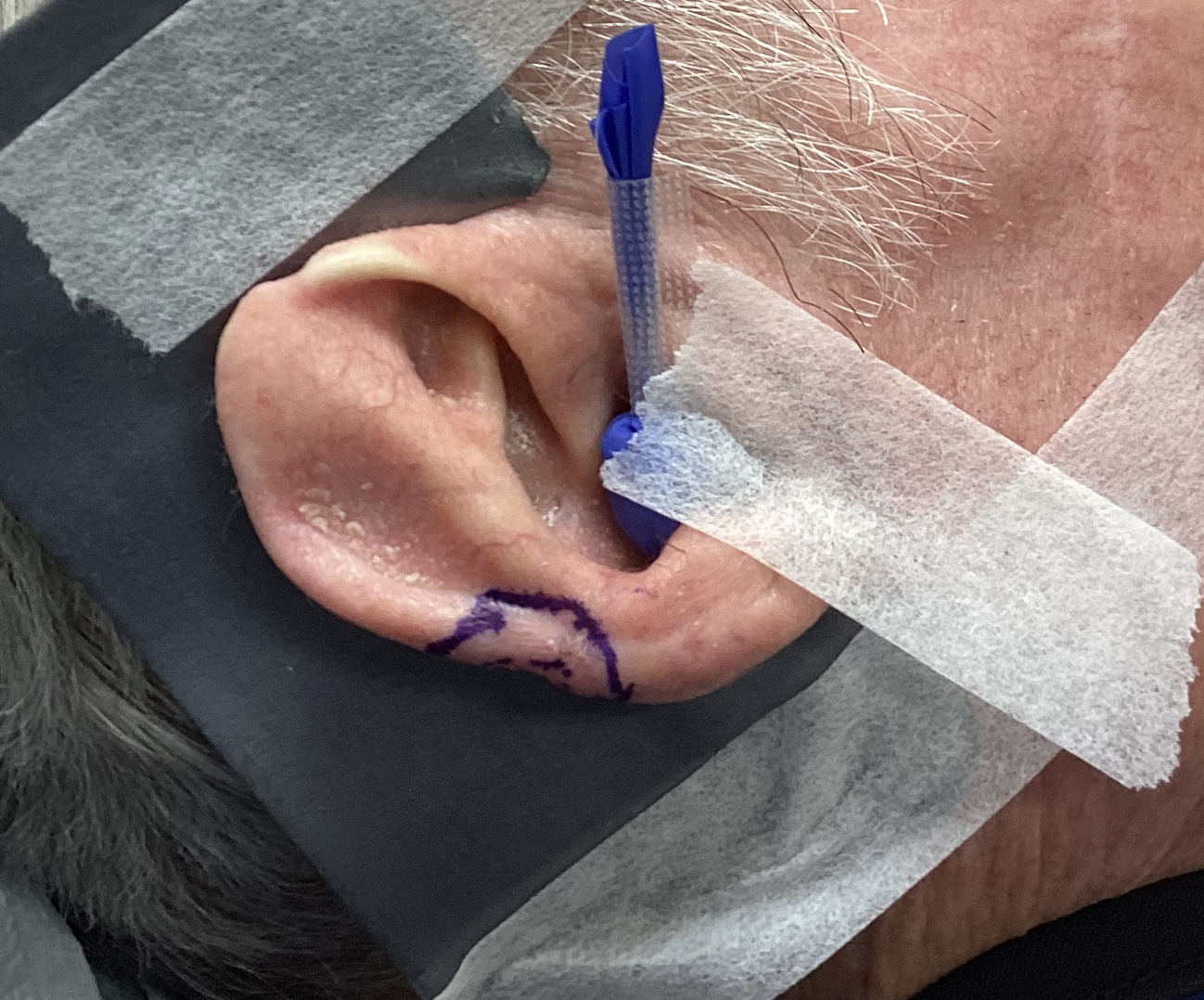 Image-Guided Superficial Radiation Therapy