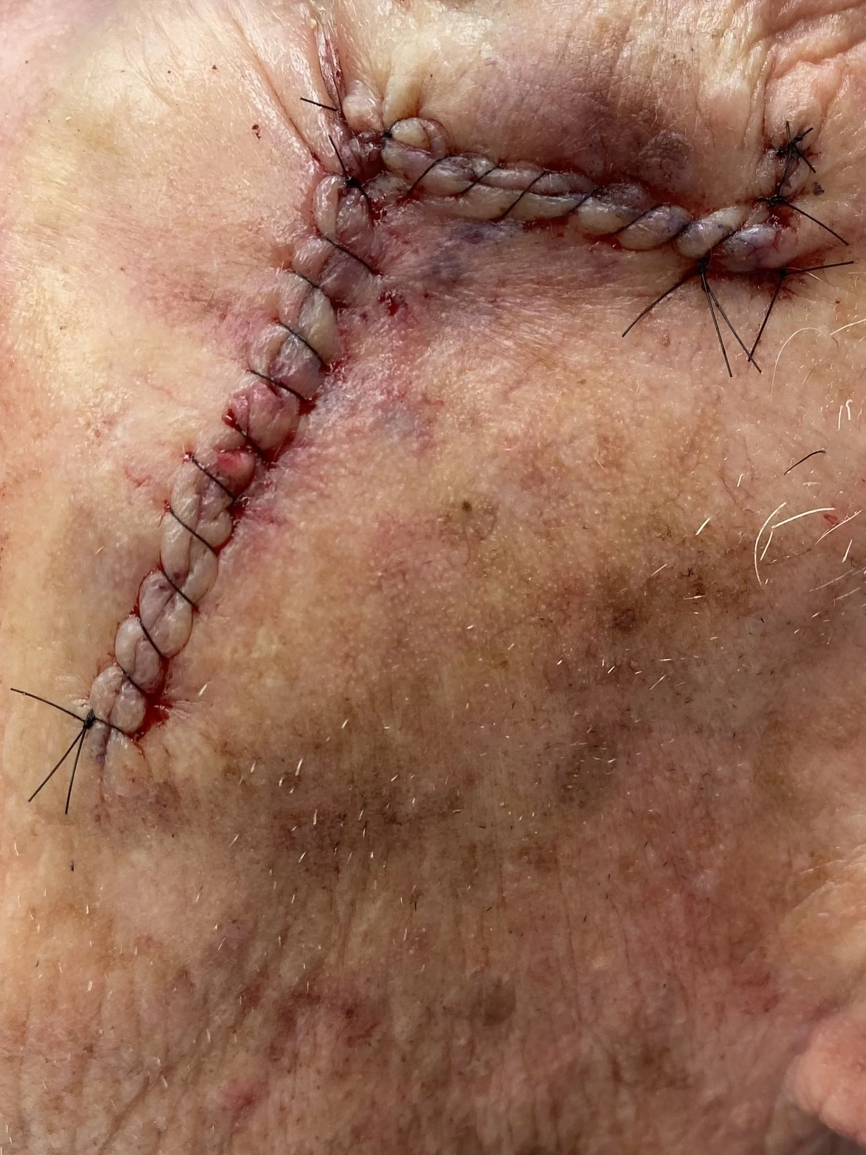 What Patients Worry About Most When Diagnosed with Skin Cancer