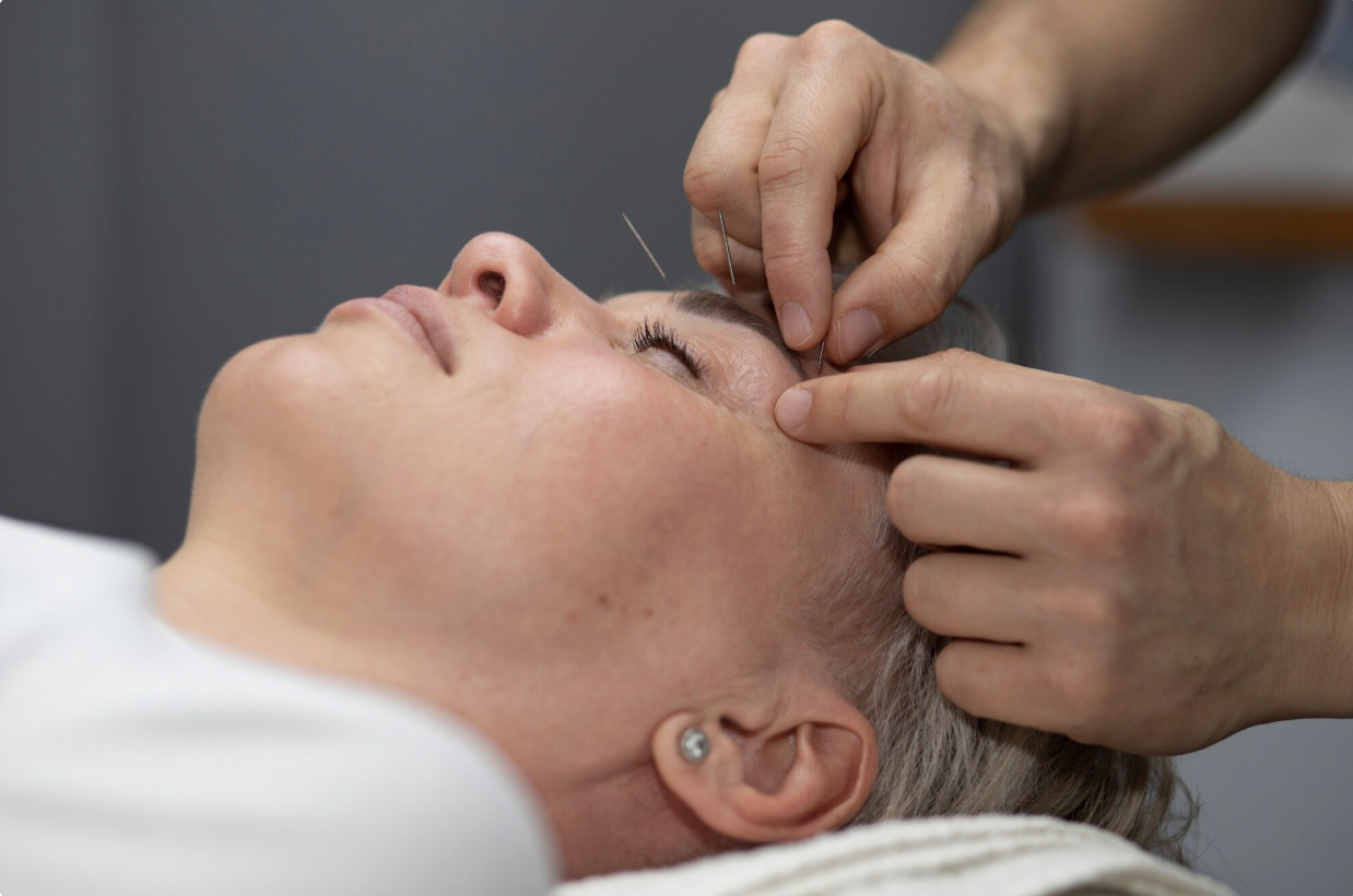 A person receiving acupuncture treatment on their face with thin acupuncture needles inserted near the eye area.