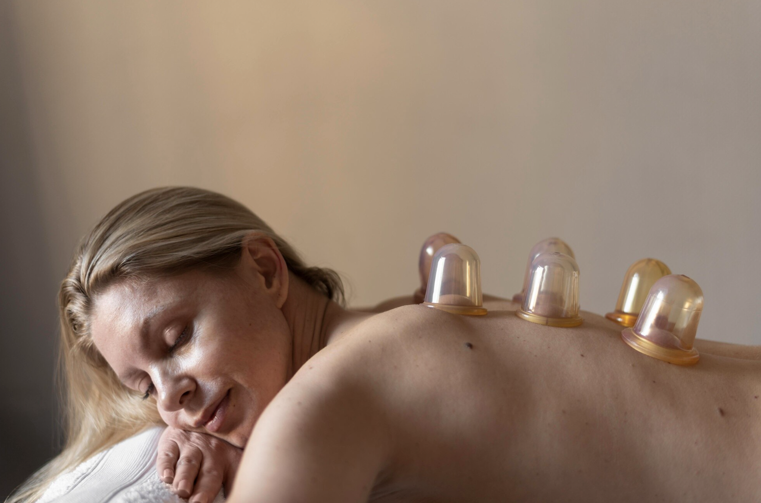 A woman receiving a cupping therapy session with several glass cups placed on her back.