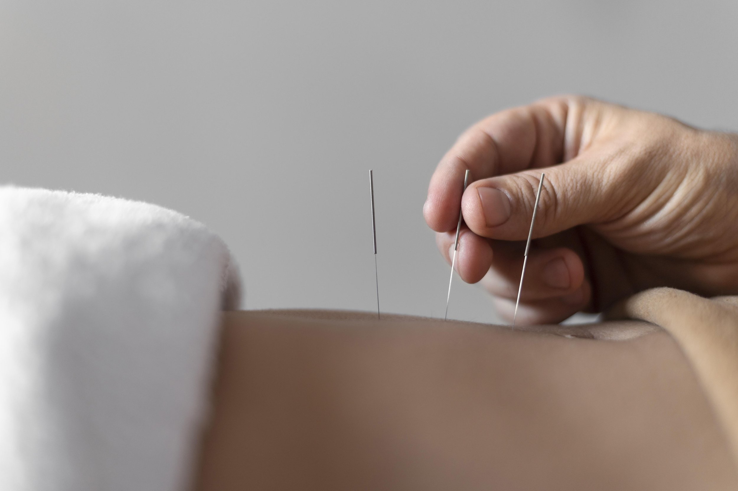 A person performing acupuncture on a patient's back using thin needles.