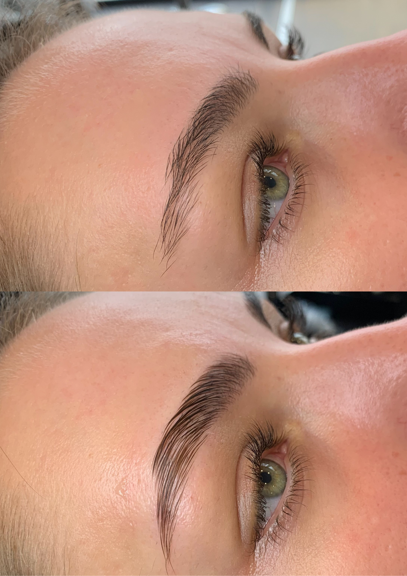 Brow Lifting