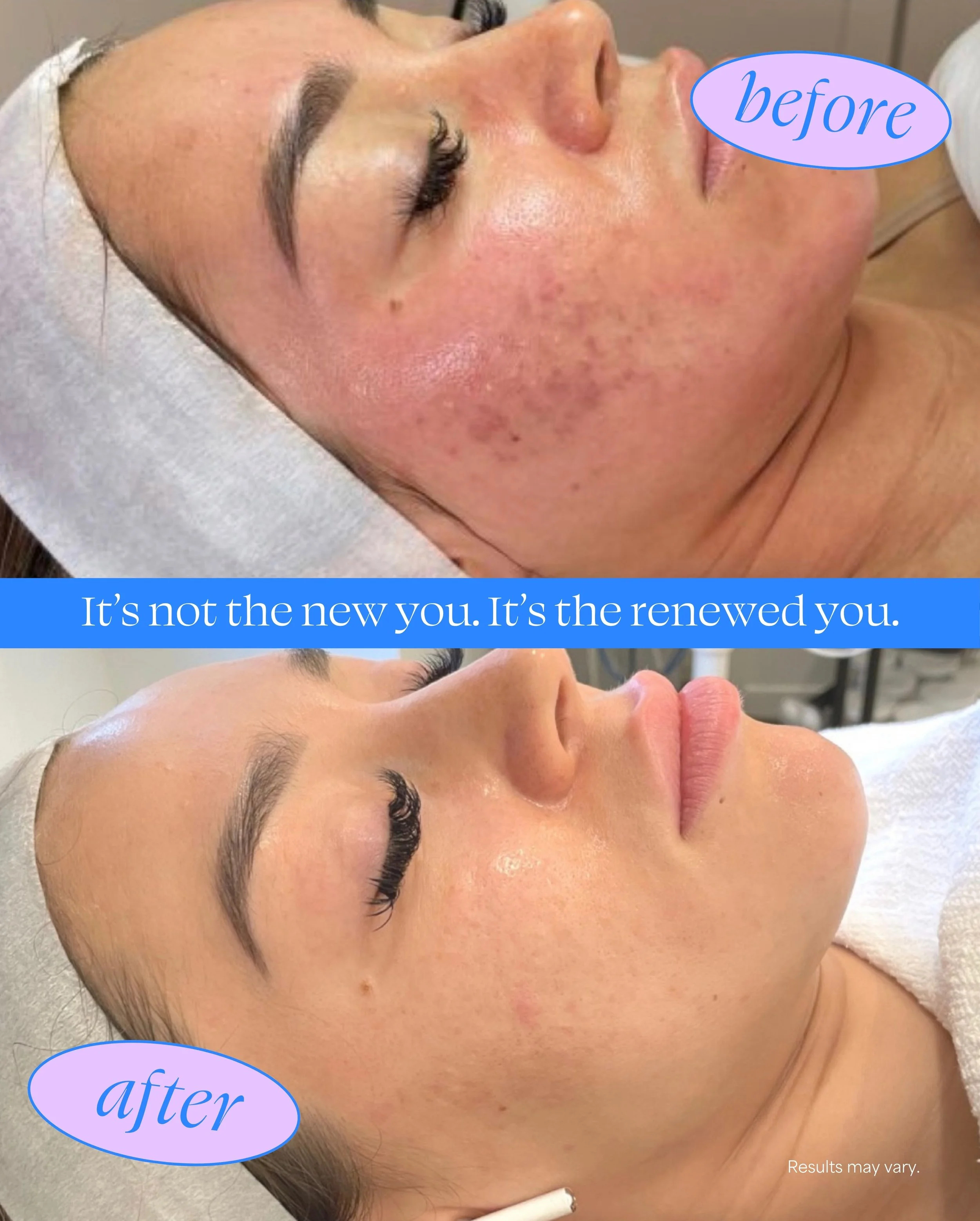 Close-up side view of a woman's face showing a before and after comparison of skincare or cosmetic treatment. The top part of the image is labeled 'before' and the bottom part 'after.' The skin appears smoother and clearer in the after photo. Text at the bottom reads, 'Results may vary.'
