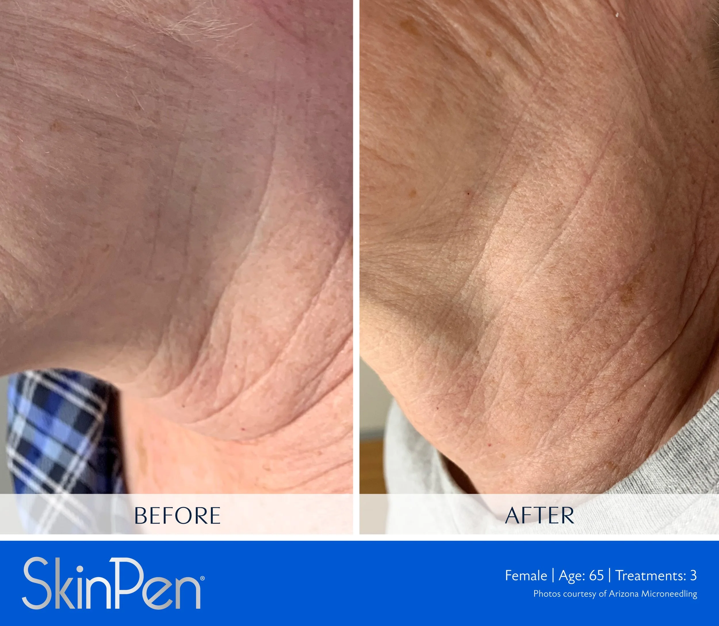 Comparison of skin texture before and after skin treatment, showing improved skin condition on the right side.