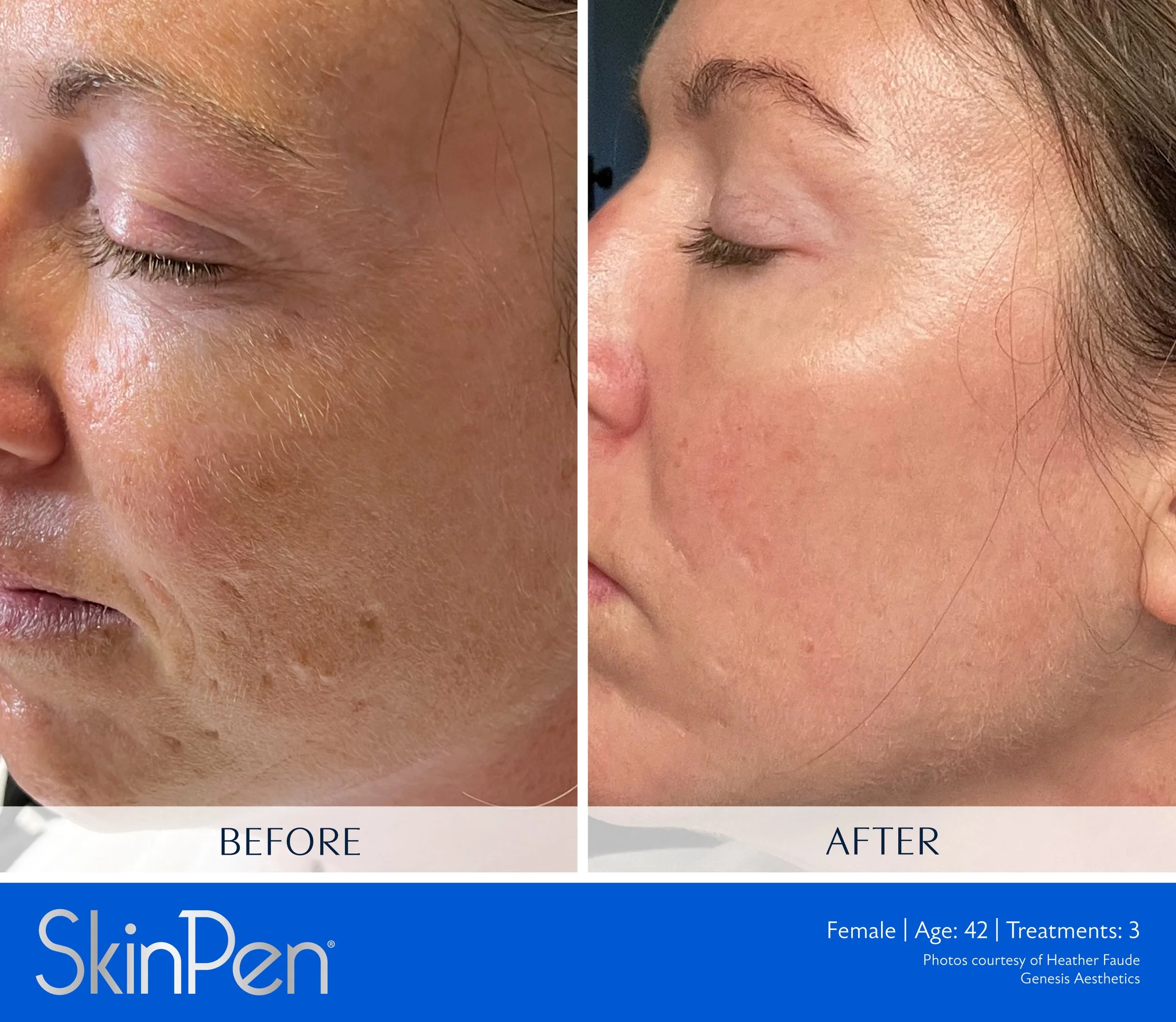 A side-by-side comparison of a woman's face before and after skincare treatment. The 'before' image shows skin with redness, uneven tone, and visible blemishes. The 'after' image shows clearer, smoother skin with a more even tone and fewer blemishes.