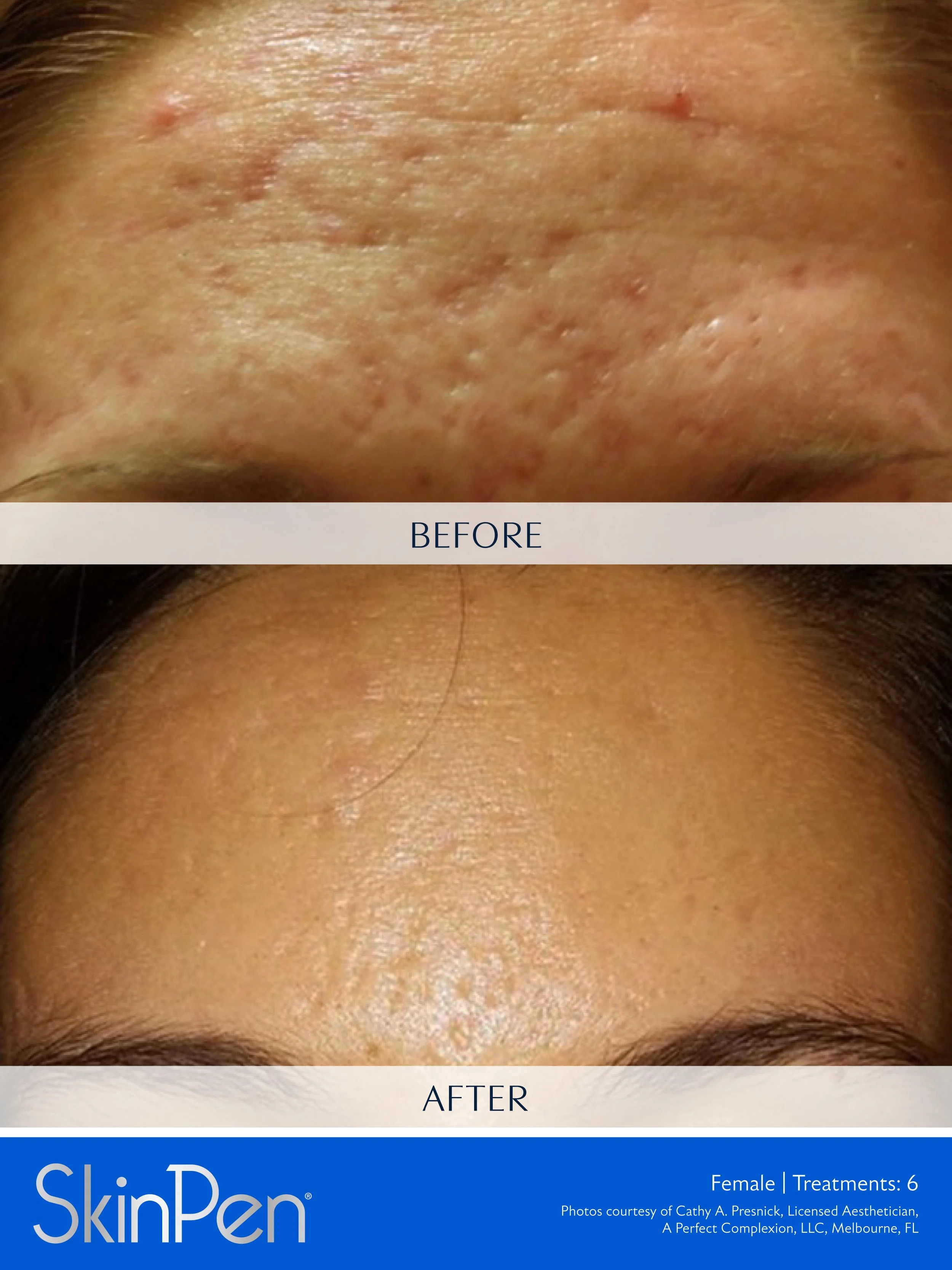 Close-up of a person's forehead before and after treatment, showing reduction of acne scars and skin smoothness.
