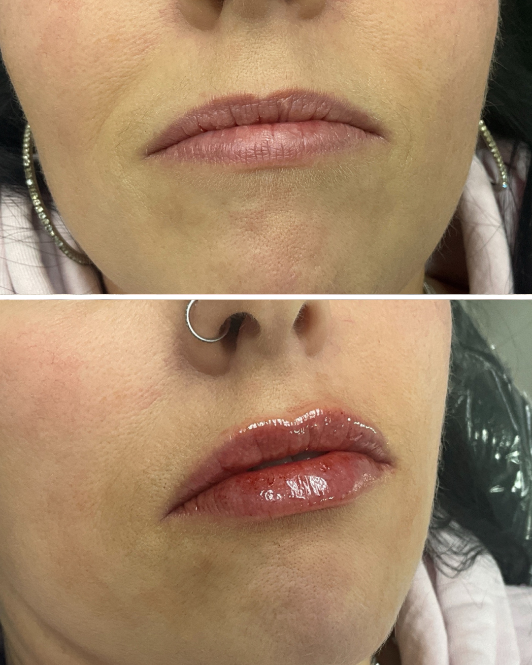 Lip Filler (1 Full Syringe)
