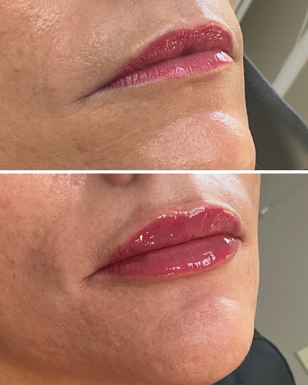 Lip Filler (1 Full Syringe)