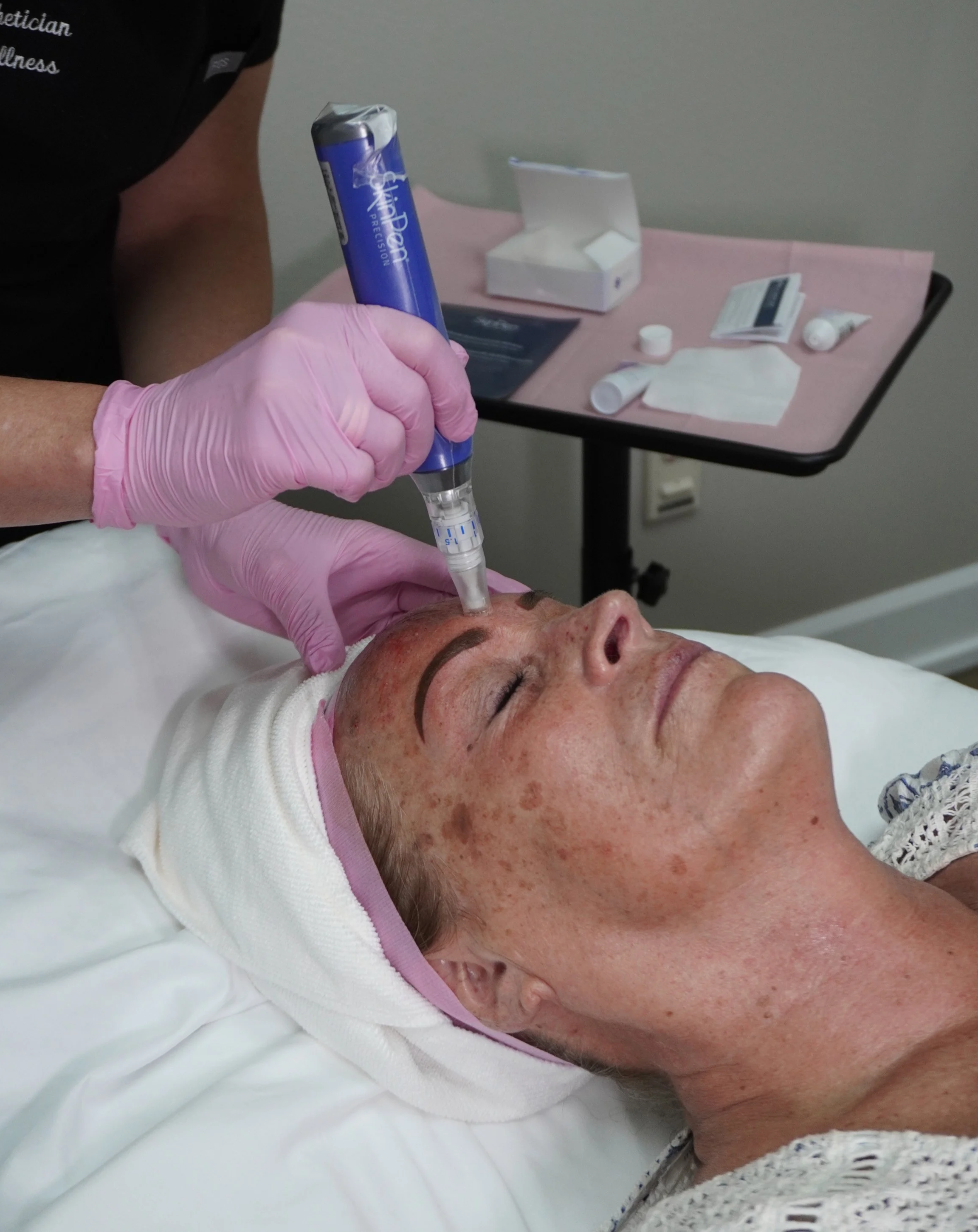 Microneedling skin rejuvenation treatment at Revive Wellness in Kennewick WA