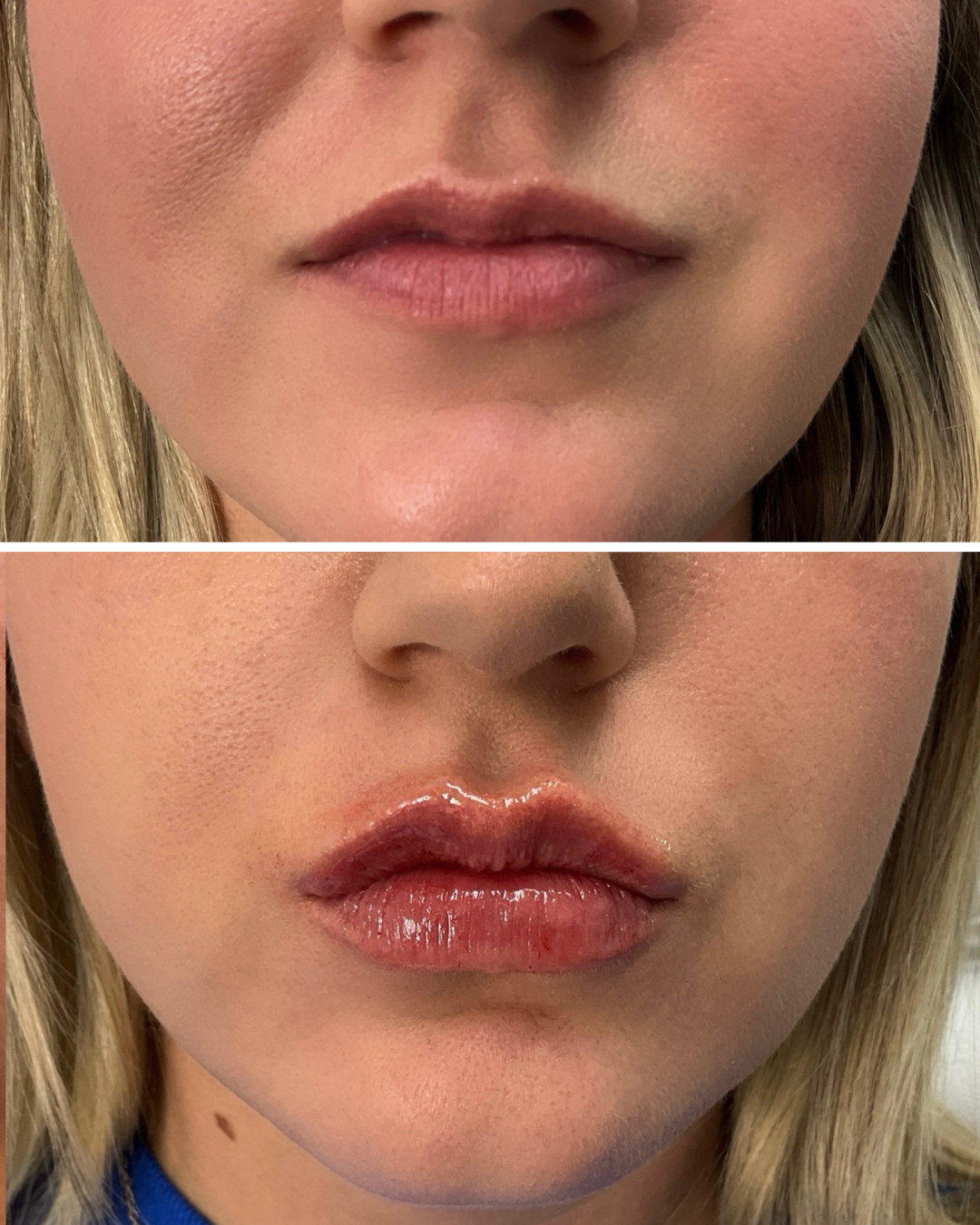 Lip Filler (Half Syringe)