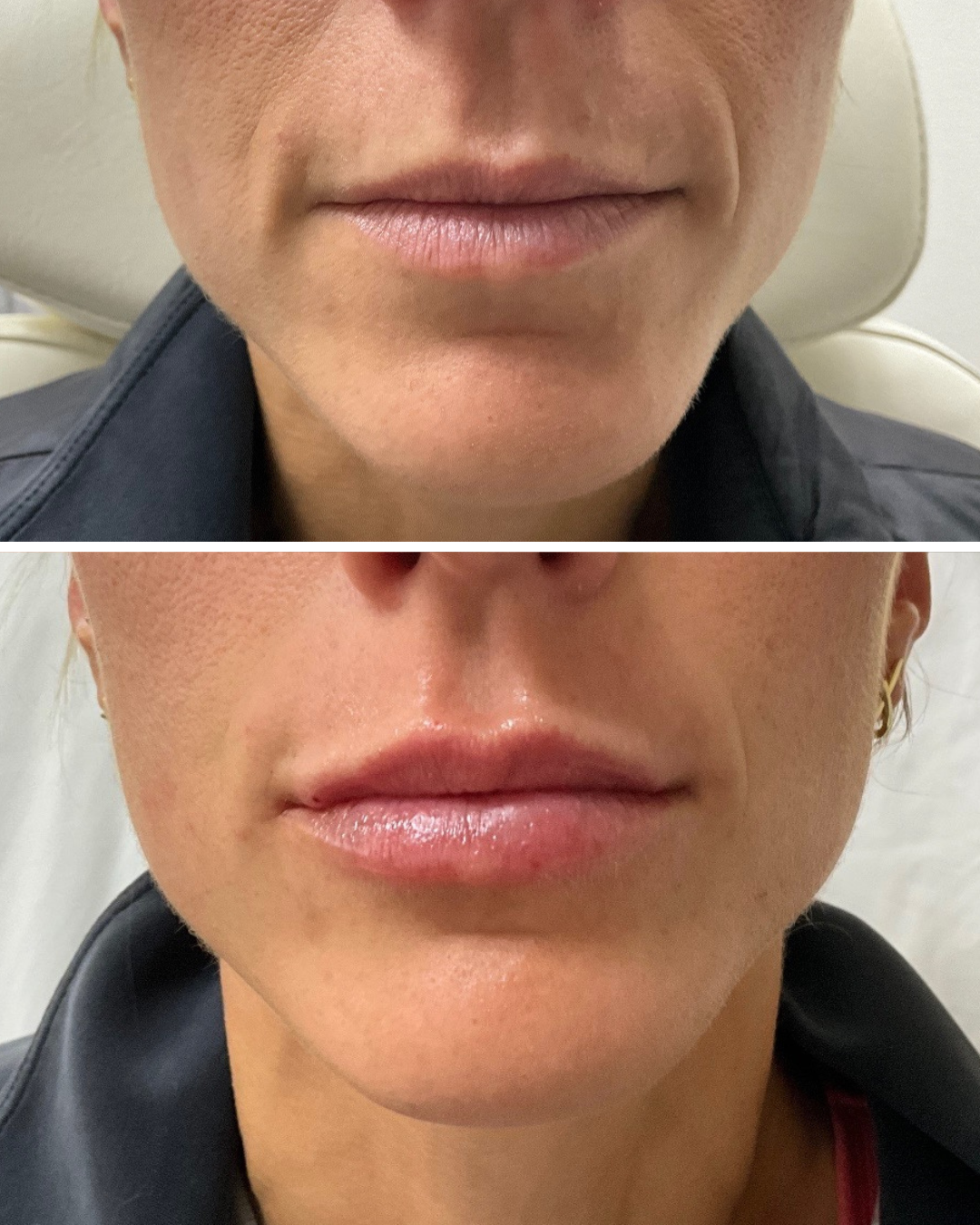 Lip Filler (1 Full Syringe)