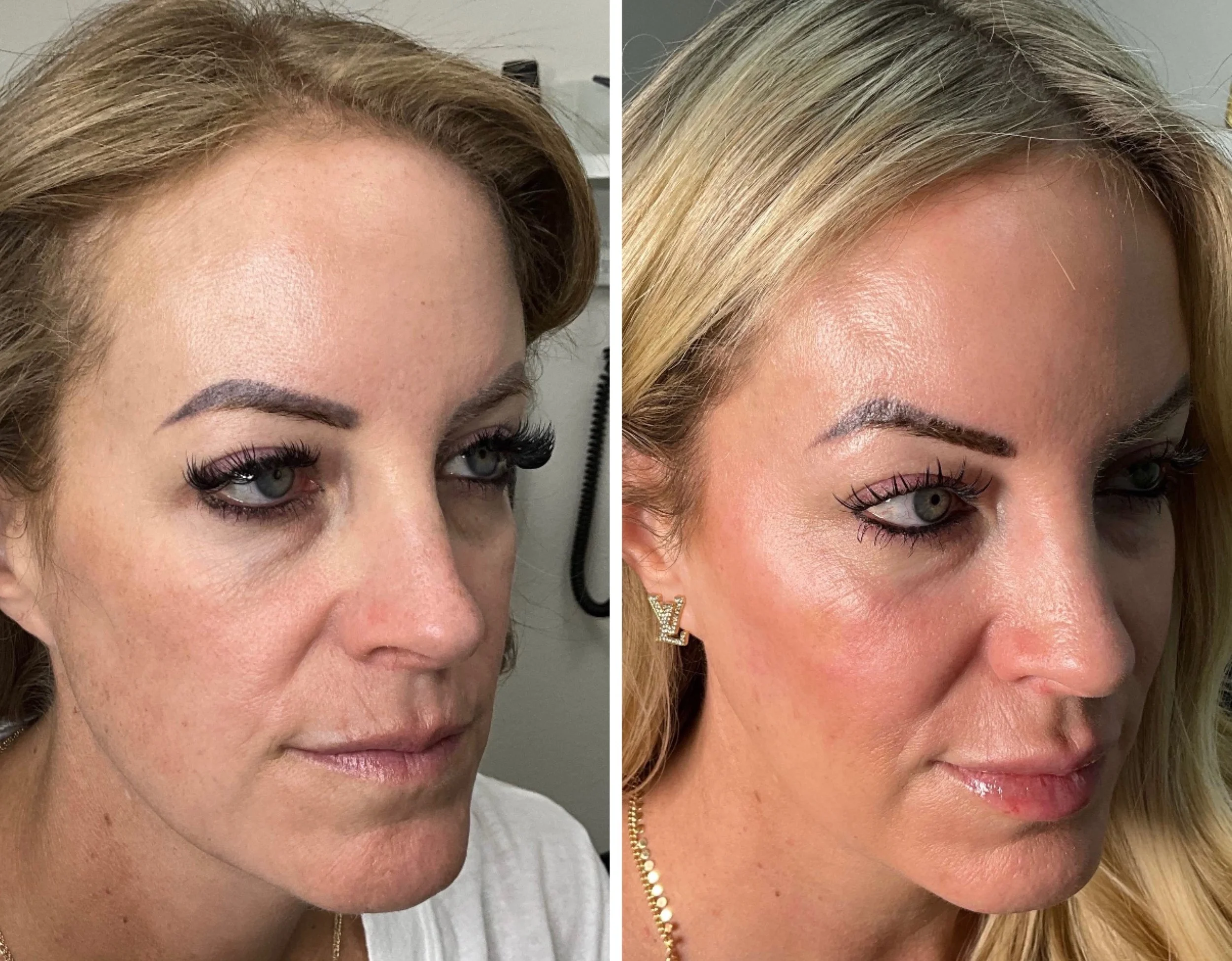 Radiesse (Cheeks & Jawline)