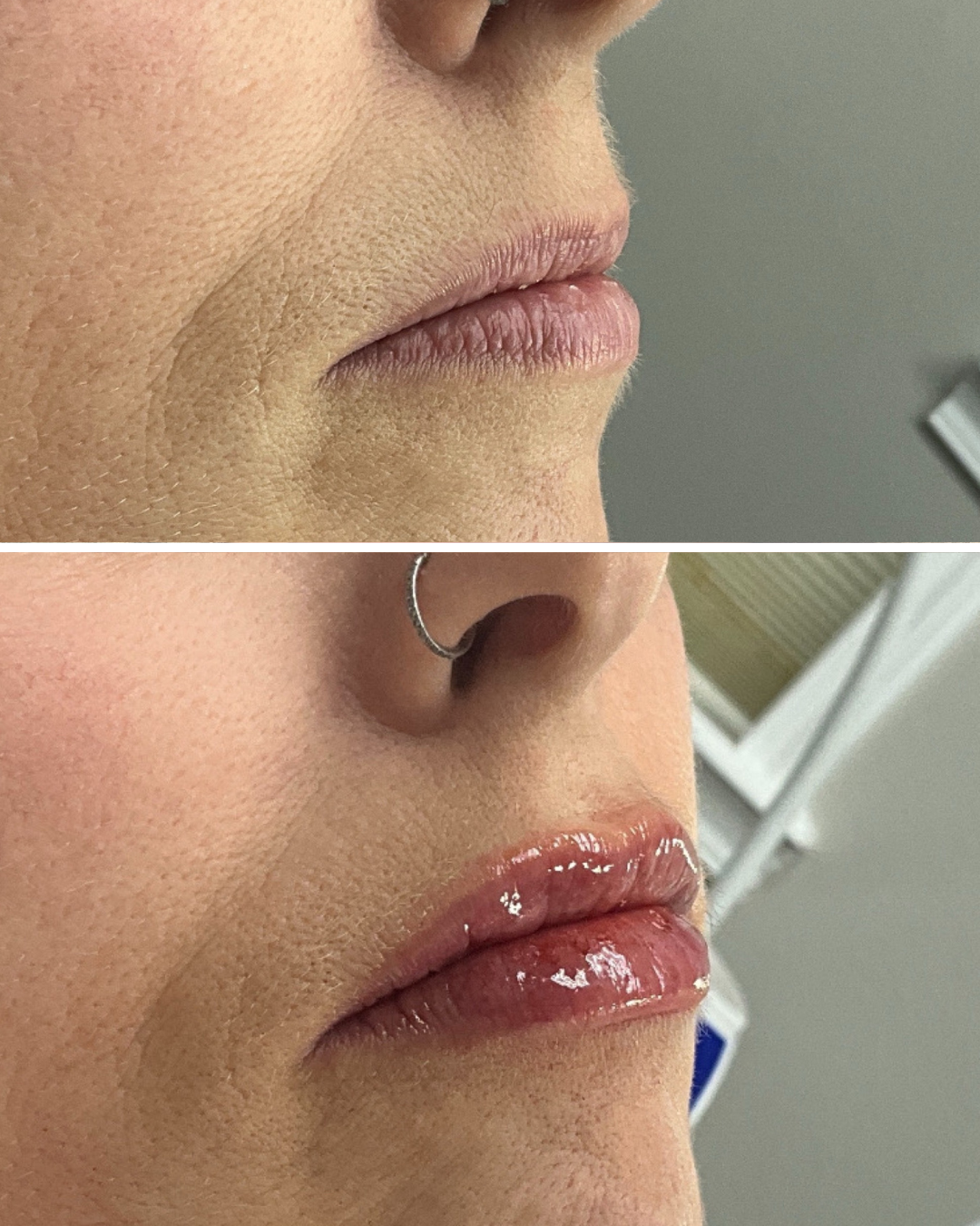 Lip Filler (1 Full Syringe)