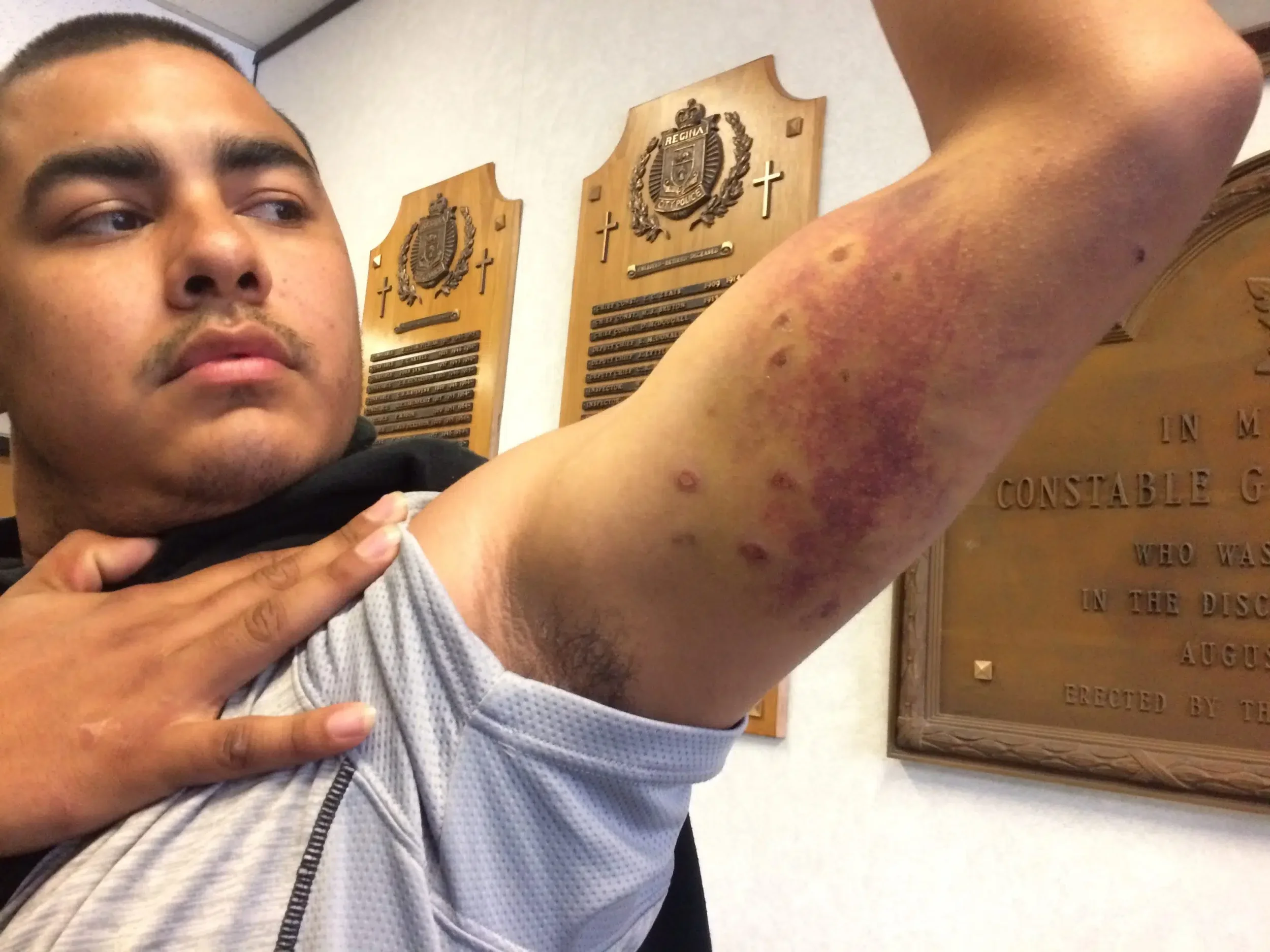 A man showcasing his armpit with multiple bruises and skin discoloration on his raised arm, standing in front of wooden plaques with engraved text.