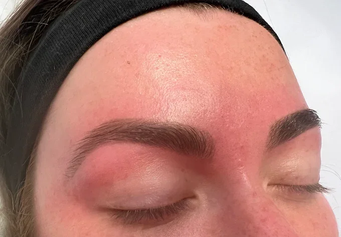 Close-up of a woman's forehead with redness, her eyes closed, and eyebrows groomed.