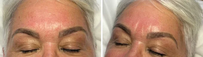 Close-up of a woman's forehead and eyes, showing her eyebrows and skin with some redness and fine lines.