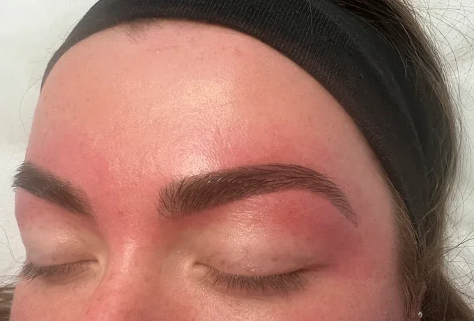 Close-up of a person's closed eyes and eyebrows showing redness and swelling around the eyebrows, possibly after cosmetic or beauty treatment.