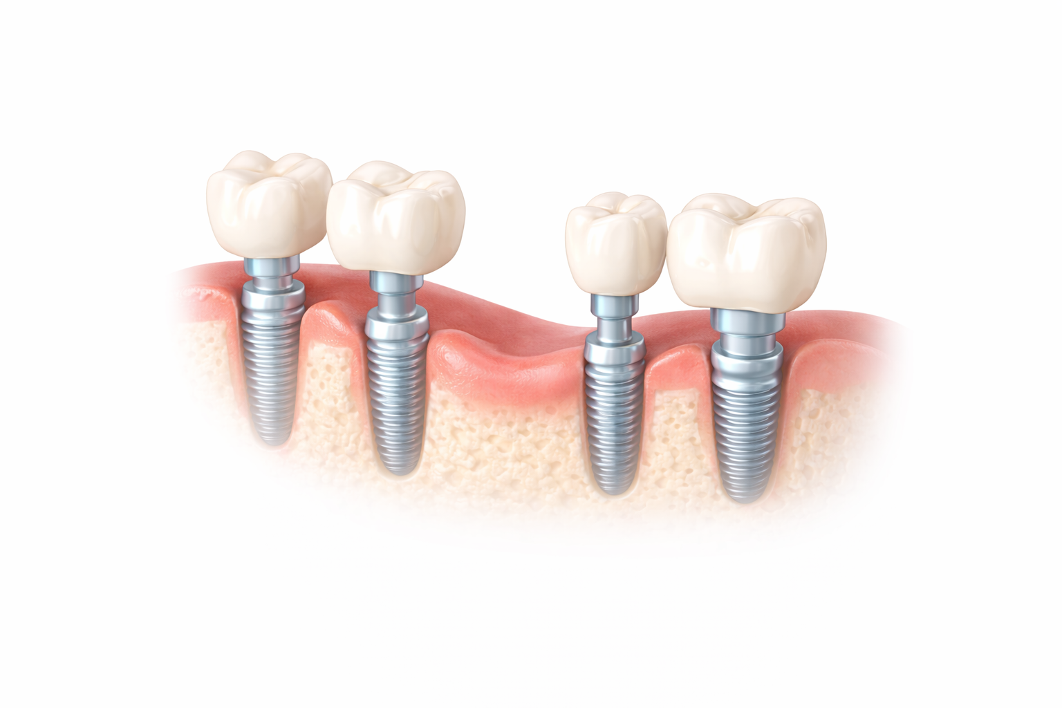 Dental implants with artificial teeth replacing molars in the lower jaw.