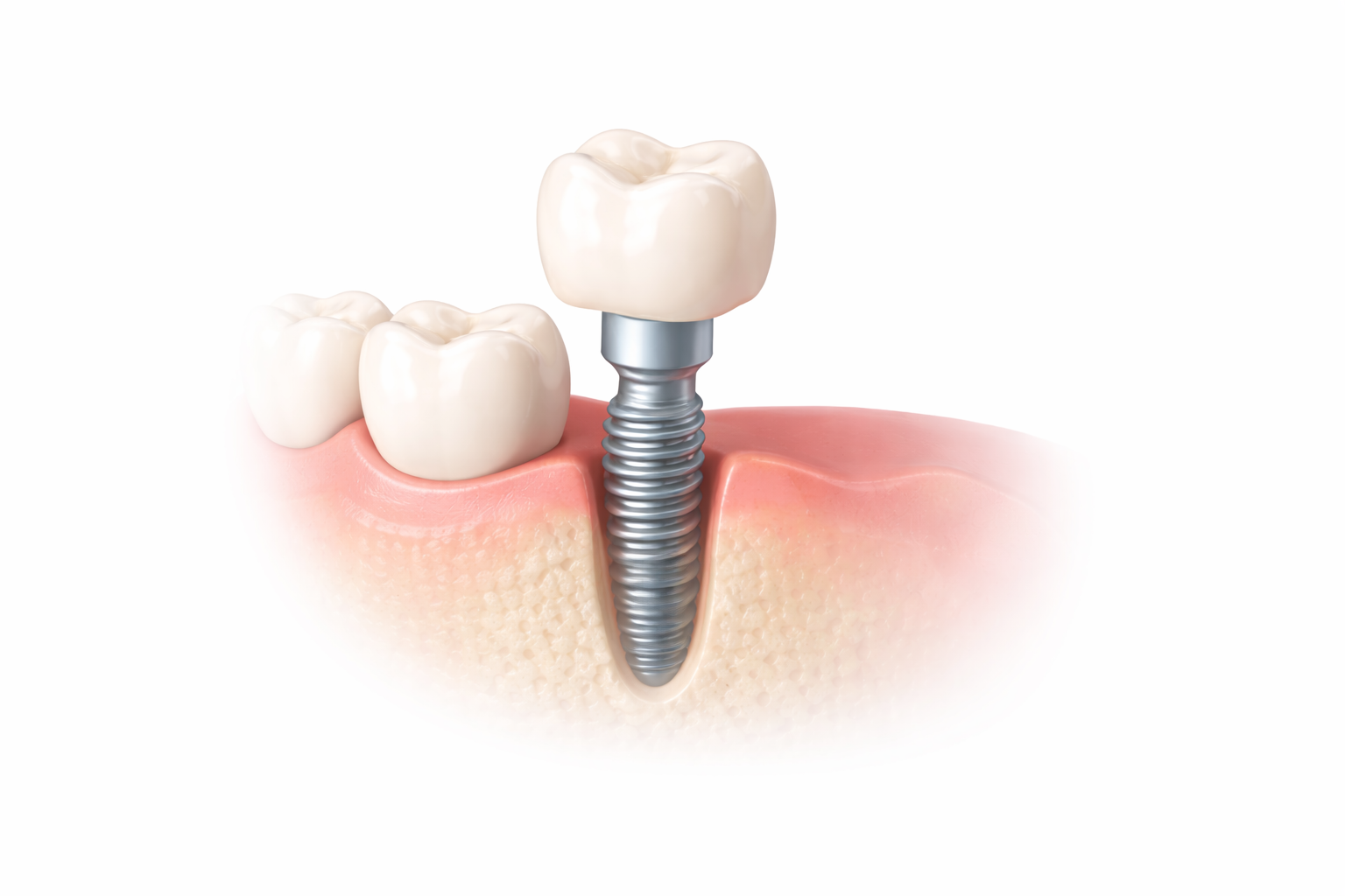 Illustration of a dental implant with a metal screw in the jawbone replacing a missing tooth, surrounded by natural teeth and gum tissue.
