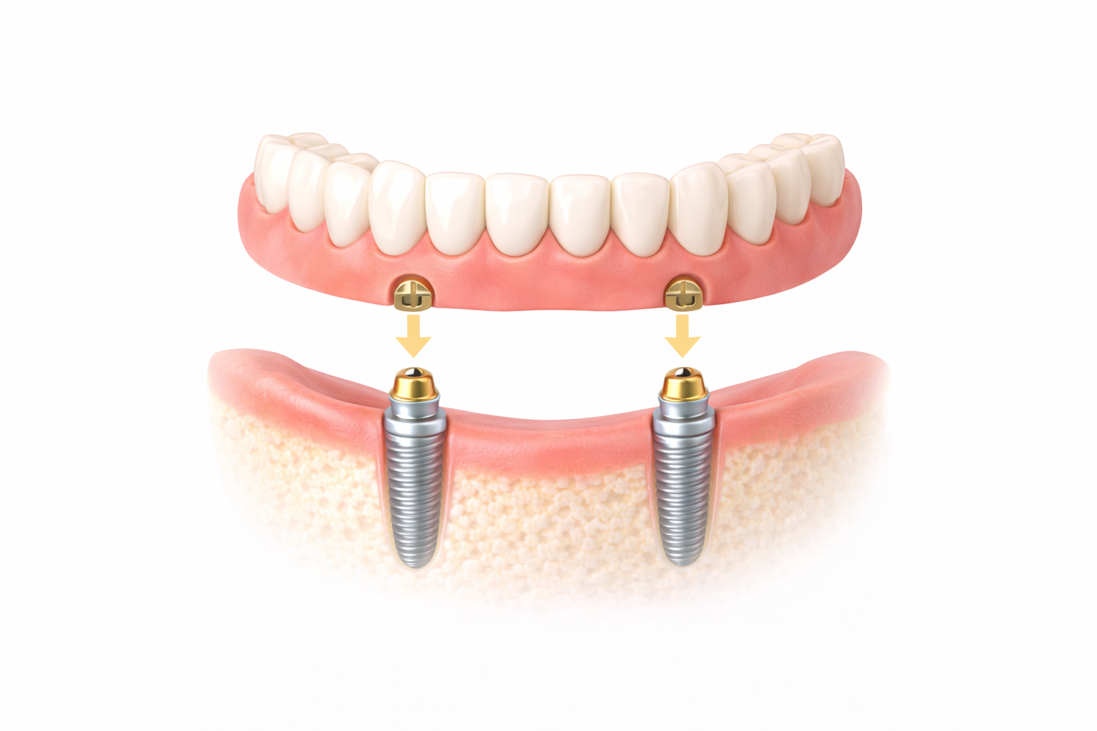 A digital illustration showing a dental implant procedure with an upper set of teeth, two implants on the lower jaw, and arrows indicating the attachment of the teeth to the implants.
