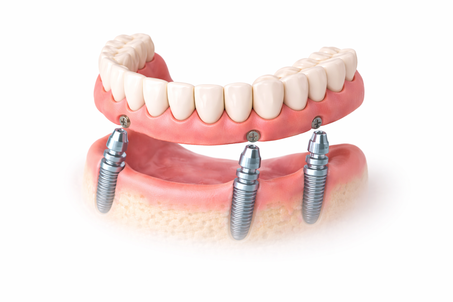 A model of a dental implant restoration with a full arch of artificial teeth attached to three dental implants.