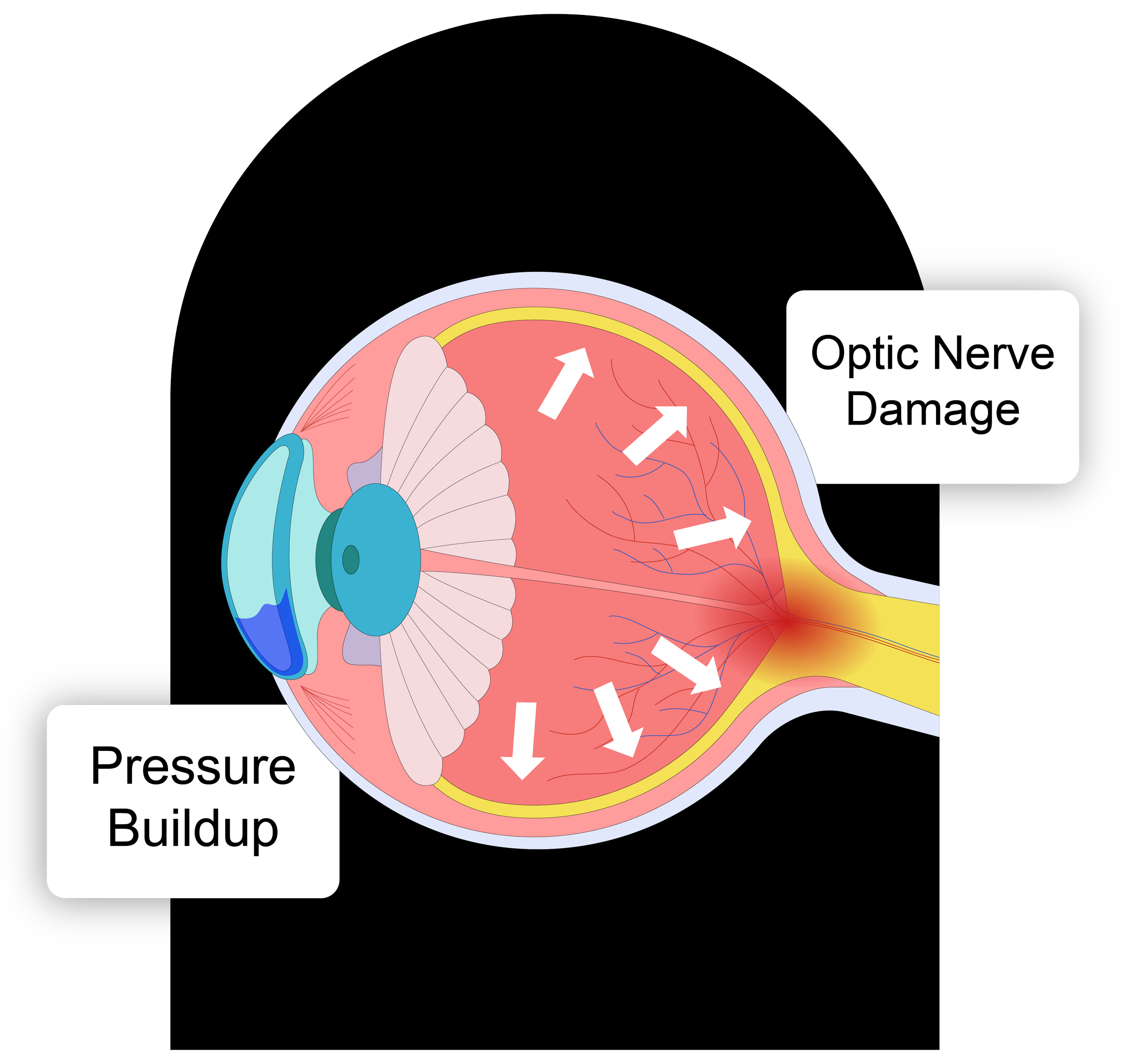 A graphic depicting what causes glaucoma that highlights the pressure buildup and optic nerve damage