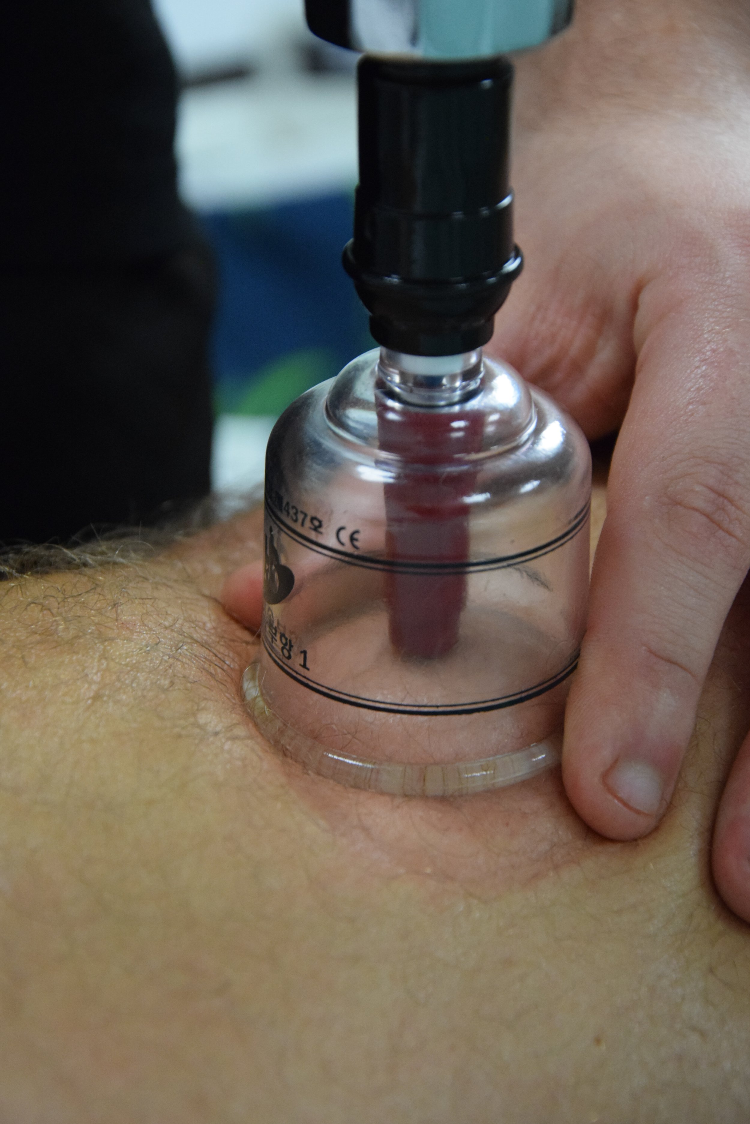Cupping Therapy: An Ancient Technique for Modern Recovery