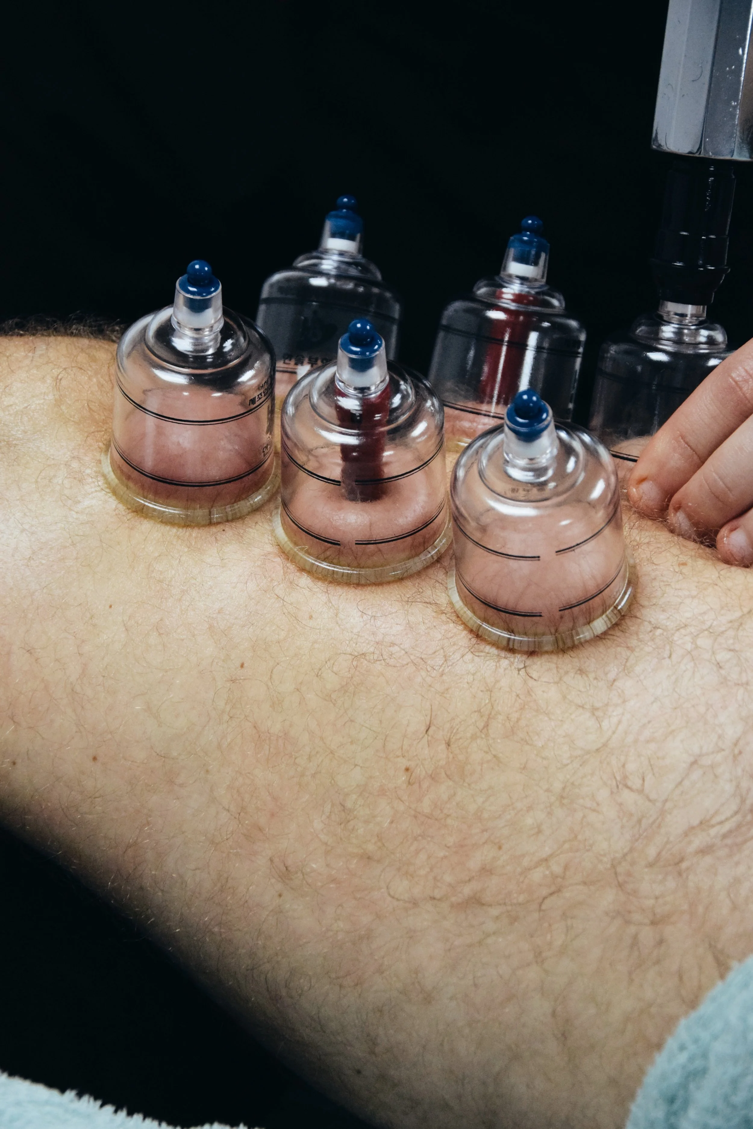 Person receiving cupping therapy with plastic cups placed on their back.