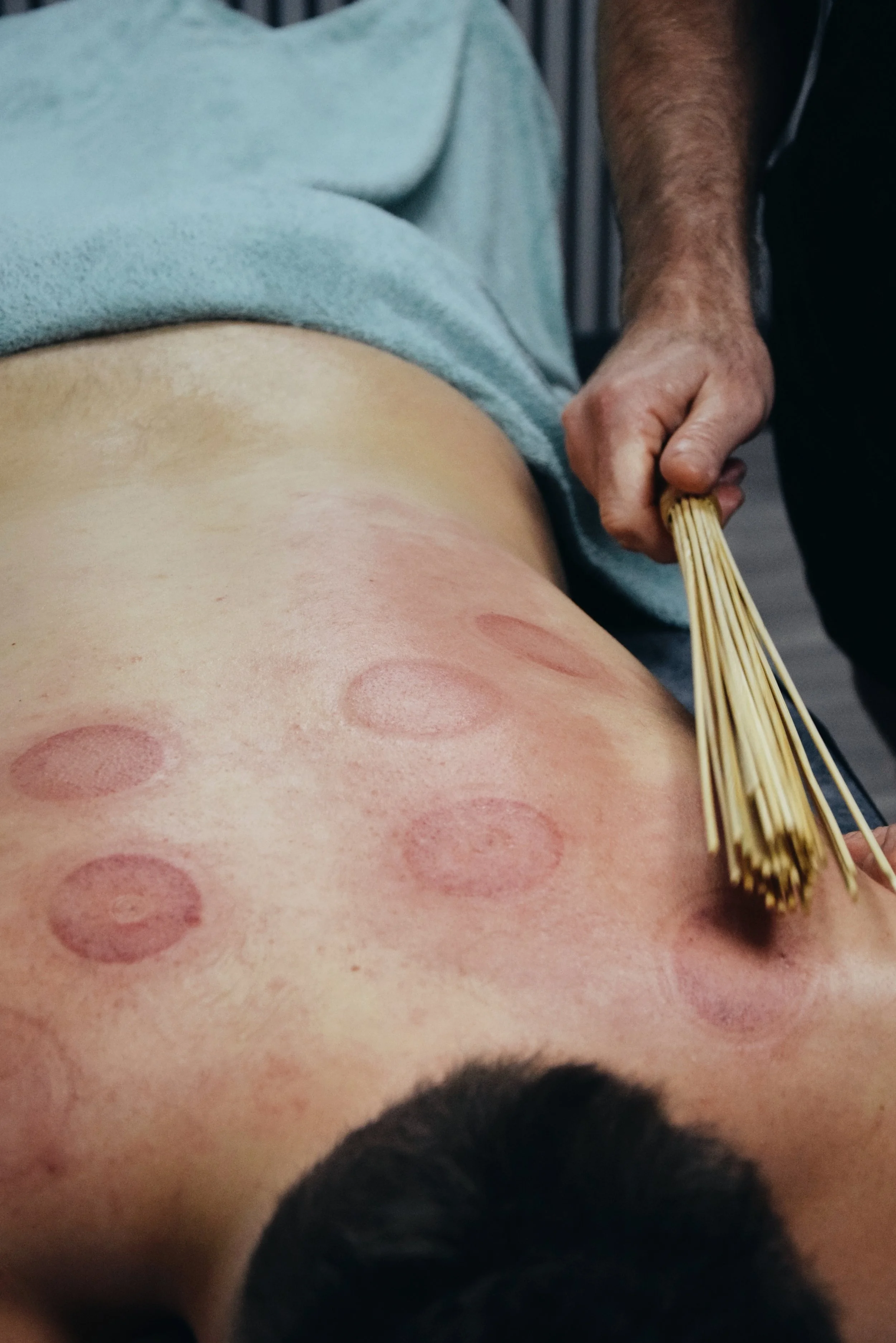 Person receiving cupping therapy on their back with several red circular marks.