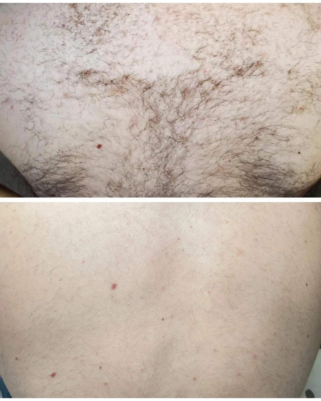 Comparison of a person's torso before and after hair removal; the top shows hairy skin, and the bottom shows smooth, hairless skin.