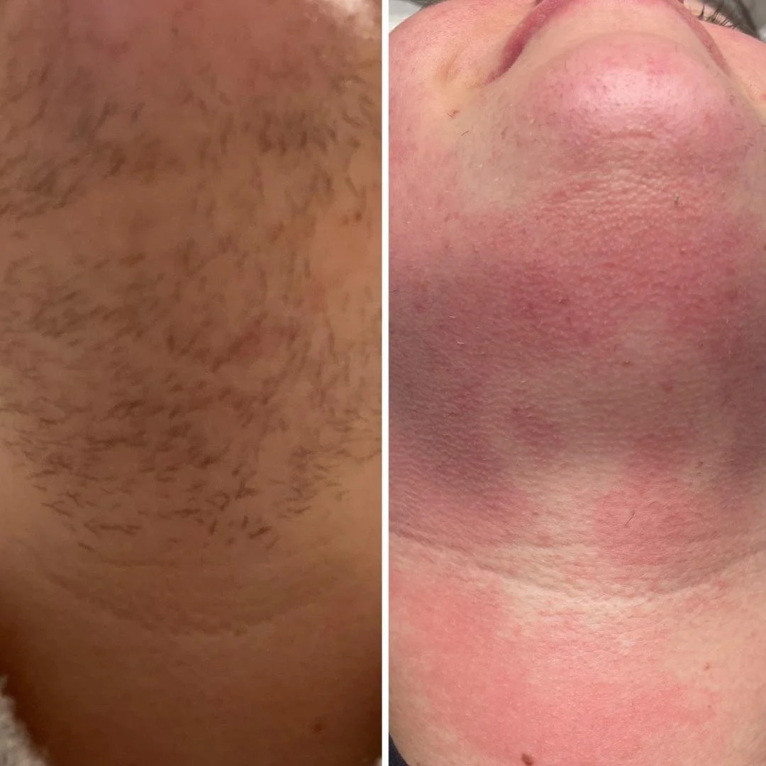 Comparison of skin before and after treatment showing reduction in hair growth and smoother skin, focusing on chin and neck area.