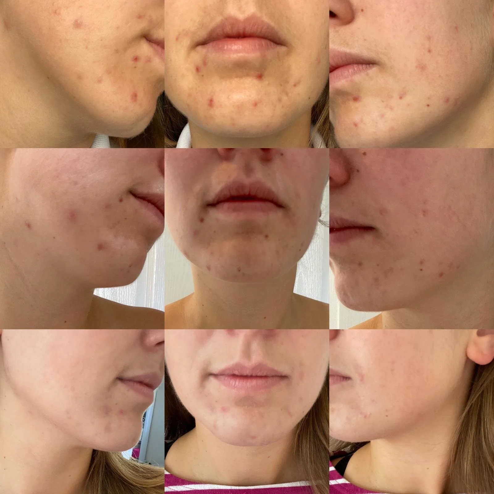 Let’s talk acne