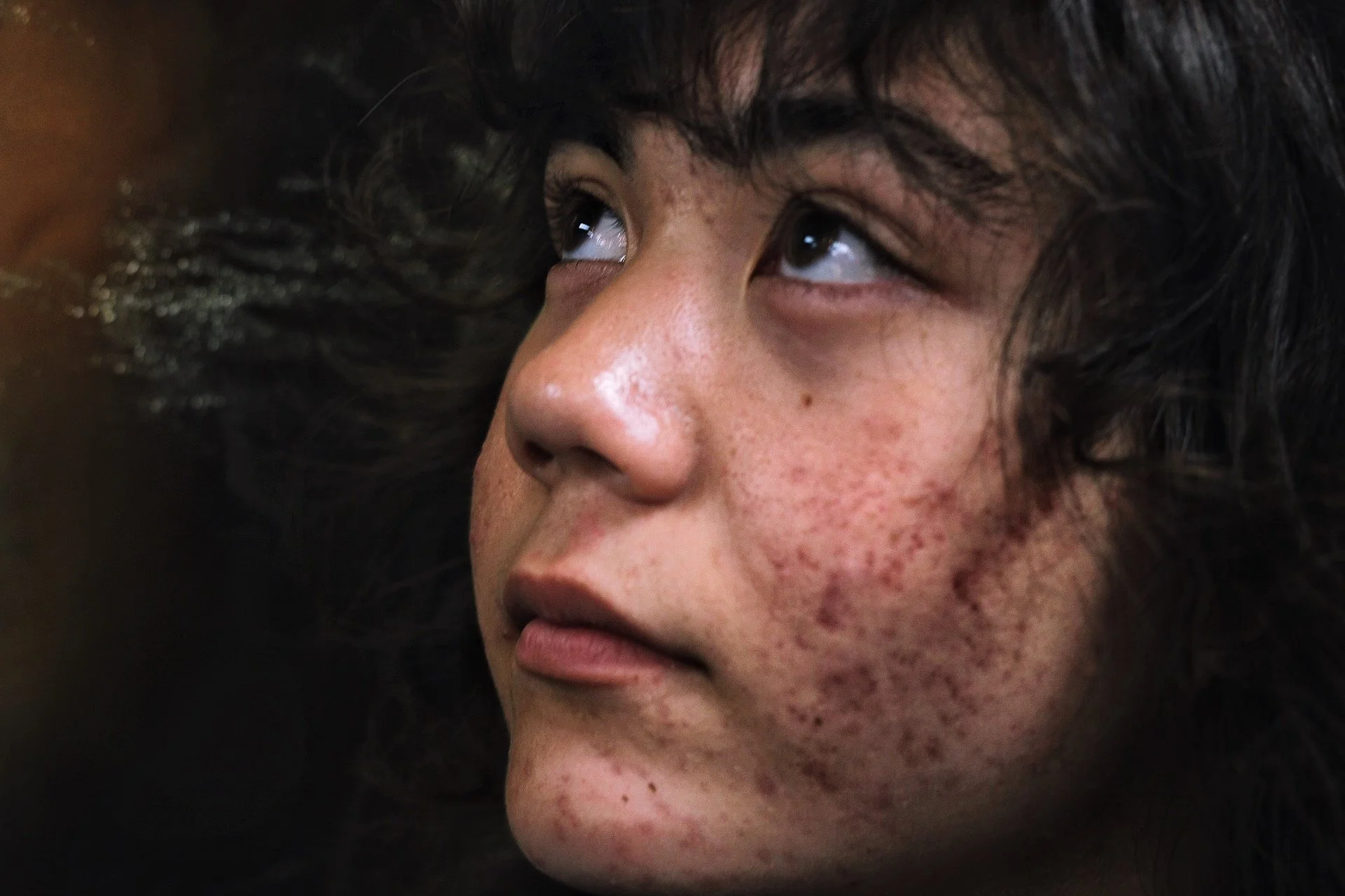 Close-up of a young woman with dark curly hair and facial acne, looking slightly upward.