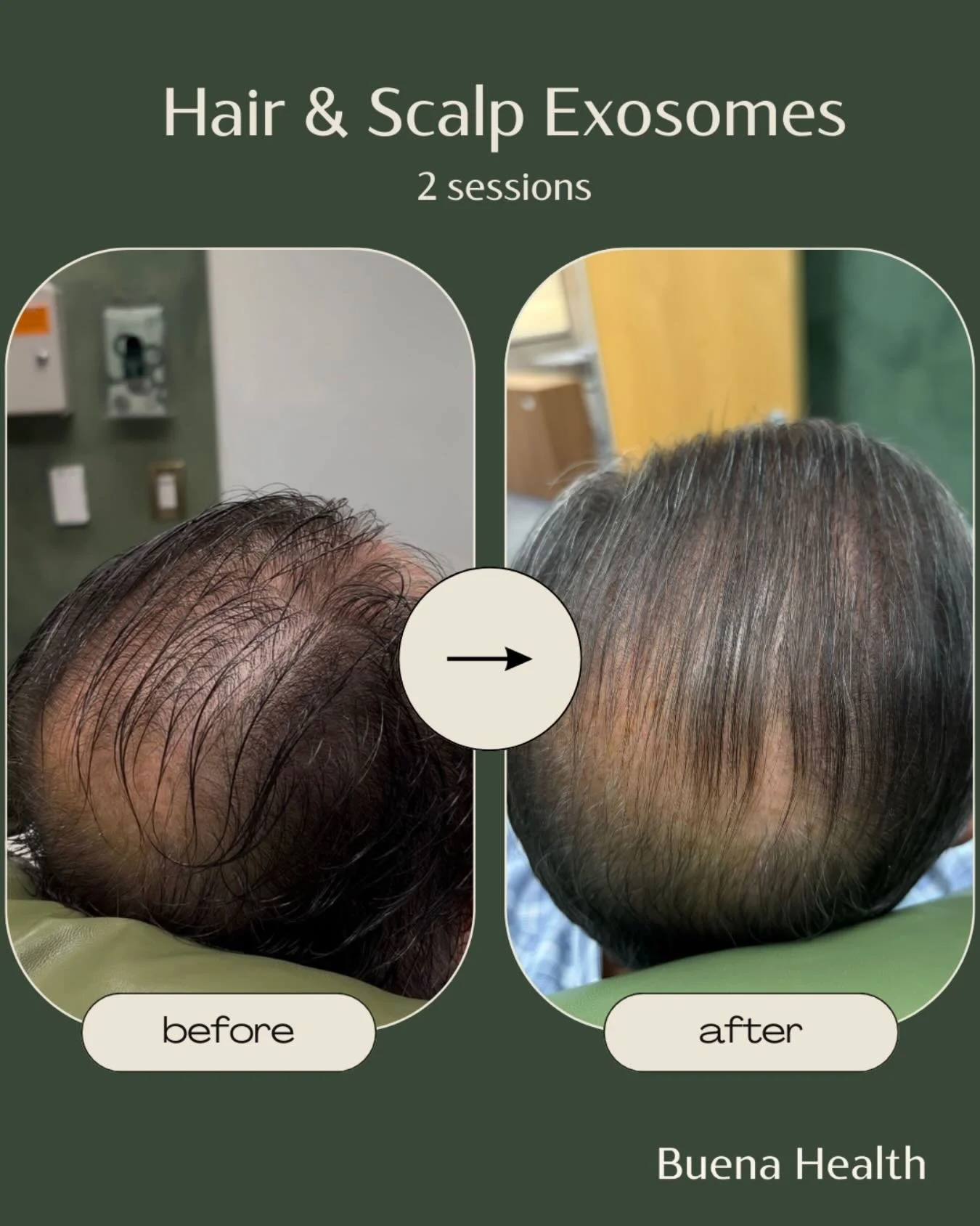 Progress you can see 👀✨
Paul is only two sessions into his hair restoration journey with us, and we&rsquo;re already seeing incredible results.

At Buena Health, we don&rsquo;t believe in one-size-fits-all. Every plan is personalized, tailored to yo