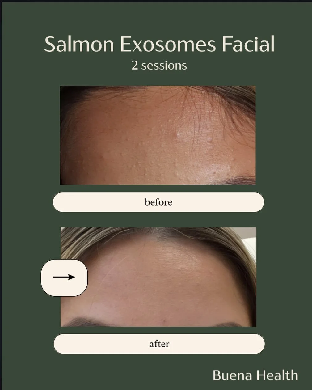 2 sessions. Real results. ✨

Our Salmon Exosome Facial helped calm breakouts, smooth texture, and restore that healthy glow 🙌

Clear skin isn&rsquo;t luck&mdash;it&rsquo;s the right treatment + consistency 💧

Ready for your own skin transformation?
