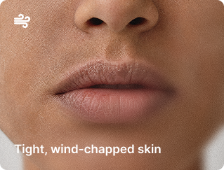 Close-up of lips and lower nose with tight, wind-chapped skin.