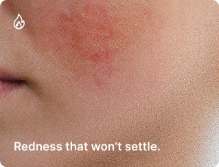 Close-up of a person's face showing redness and irritation on the cheek with the caption "Redness that won't settle."