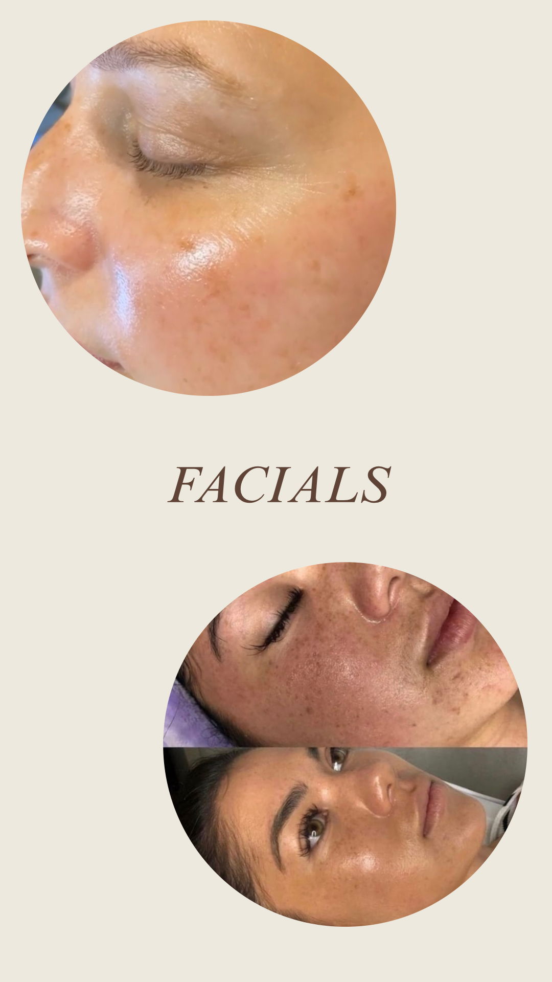 Chemical Peel - 2.PNG