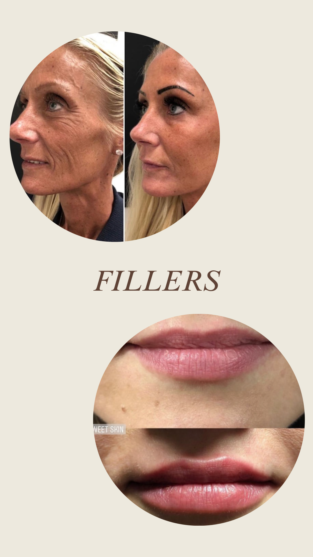 Chemical Peel - 1.PNG