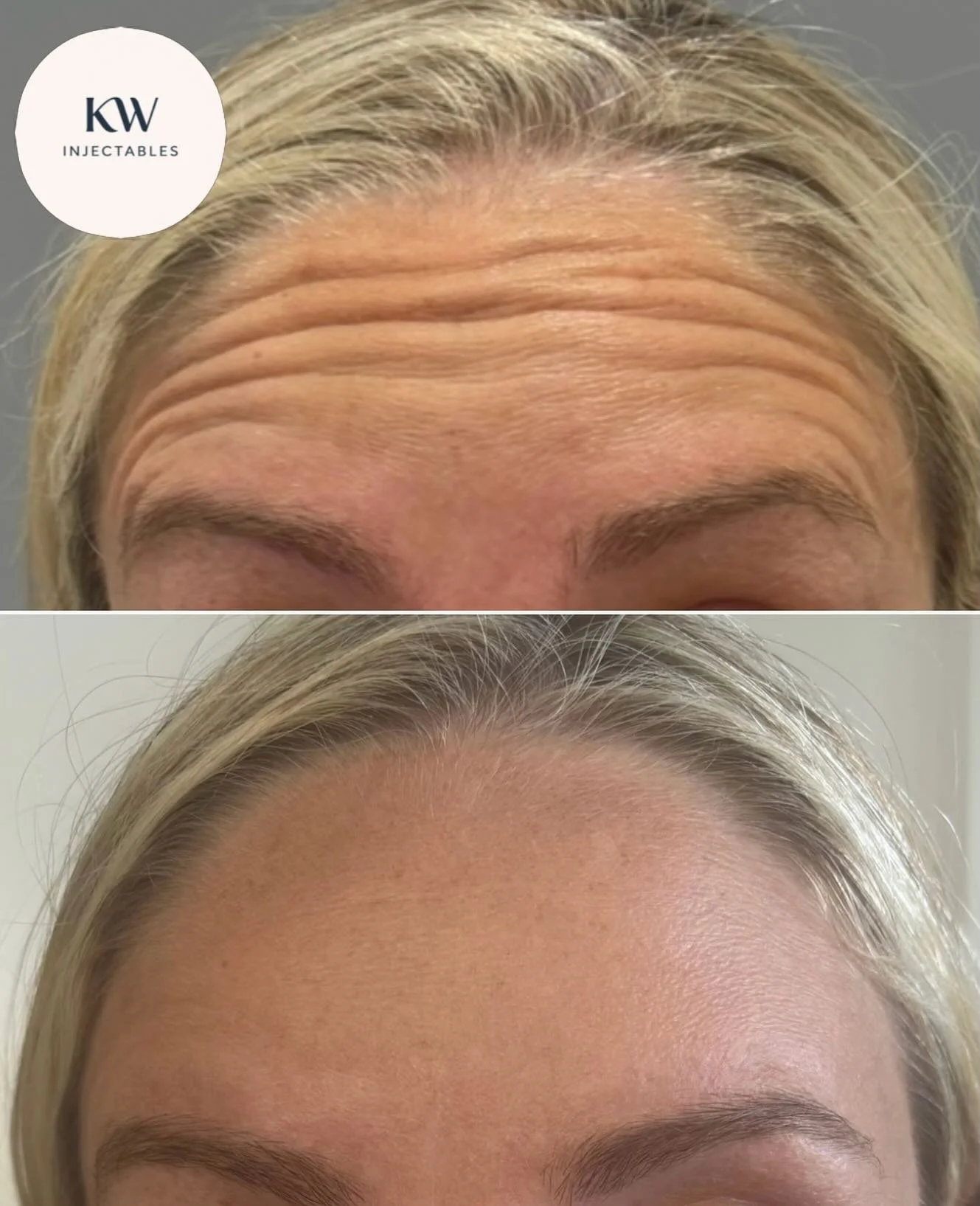 Before (above) and after (below) Dysport&reg; treatment to my client&rsquo;s forehead 🫶🏼

Mandatory statement:
Dysport&reg; is a prescription medicine for the treatment of frown lines, horizontal forehead lines and crow&rsquo;s feet around the eyes
