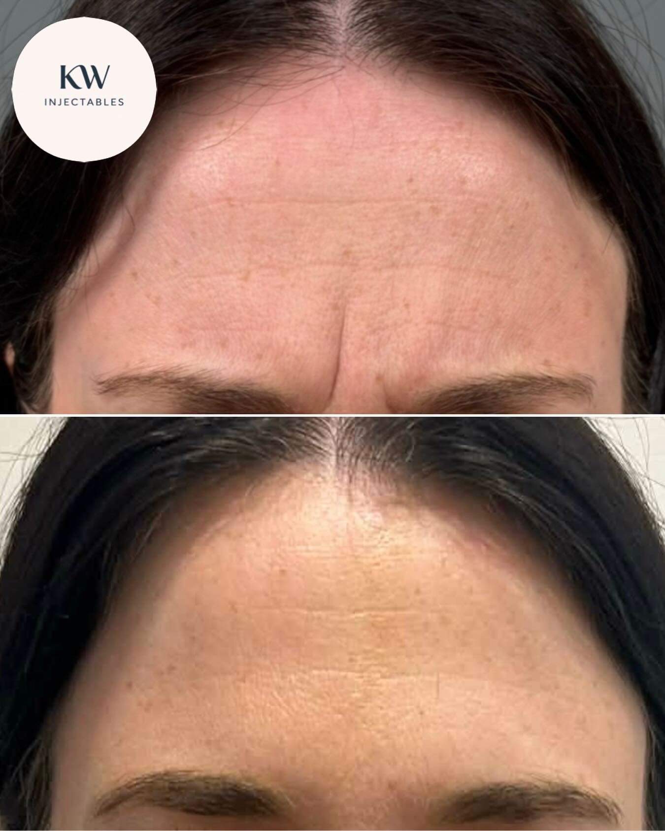 A satisfied client after receiving Dysport&reg; to her frown lines ❤️&zwj;🔥

&bull;
&bull;
&bull;

Mandatory statement:
Dysport&reg; is a prescription medicine for the treatment of frown lines, horizontal forehead lines and crow&rsquo;s feet around 