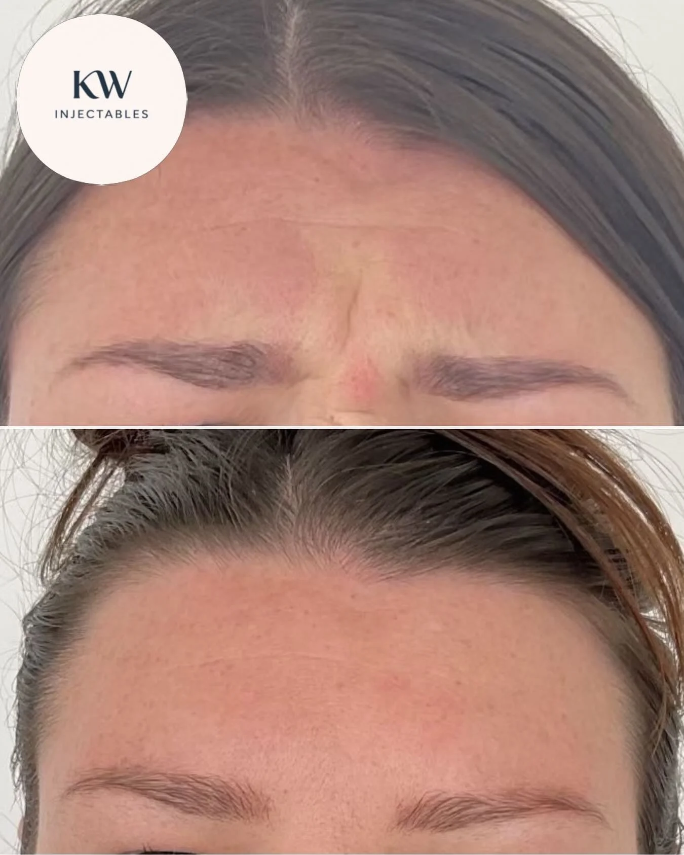 Frown lines relaxed for my lovely client after Dysport&reg; treatment ❤️&zwj;🔥

Mandatory statement:
Dysport&reg; is a prescription medicine for the treatment of frown lines, horizontal forehead lines and crow&rsquo;s feet around the eyes. Dysport&r