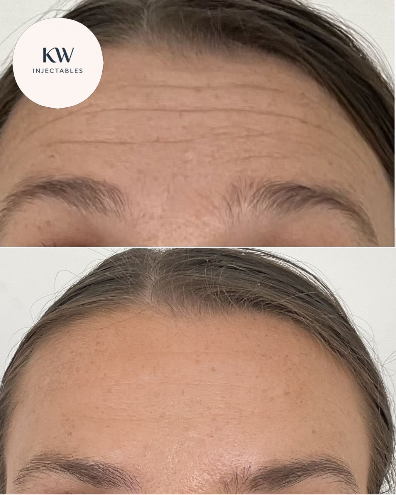 A sprinkling of Dysport&reg; across my client&rsquo;s forehead❤️&zwj;🔥😍

⚡️Book now at www.kwinjectables.com or click the link in my bio⚡️ 

Mandatory statement:
Dysport&reg; is a prescription medicine for the treatment of frown lines, horizontal f