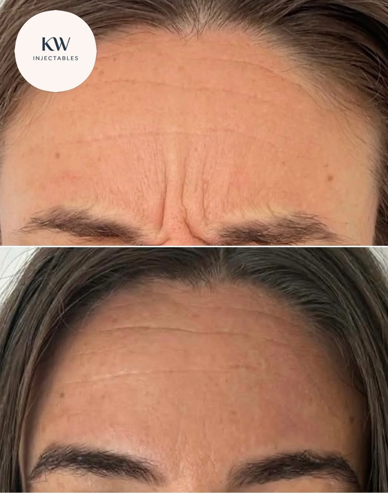 Frown lines softened for my lovely client ❤️&zwj;🔥 
It was her first time having antiwrinkle treatment so a subtle, natural look was the goal. 

❣️Interested in antiwrinkle or have questions? Book a complimentary consult today at www.kwinjectables.c