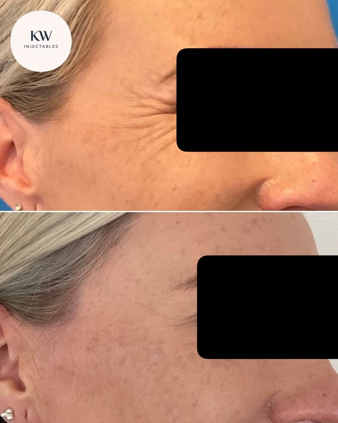 🌟Relfydess🌟 in action! What a difference this has made to my client&rsquo;s lateral canthal lines (aka crows feet). Her feedback was that it felt natural, with no tightness or heaviness sometimes experienced with other neuromodulators. 
&bull;
&bul