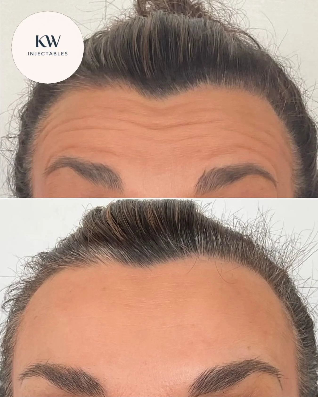 B + A Dysport&reg; treatment to my client&rsquo;s forehead ❤️&zwj;🔥 

🌻 Book your complimentary consult at www.kwinjectables.com or via the link in my bio 🌻

Mandatory statement:
Dysport&reg; is a prescription medicine for the treatment of frown l
