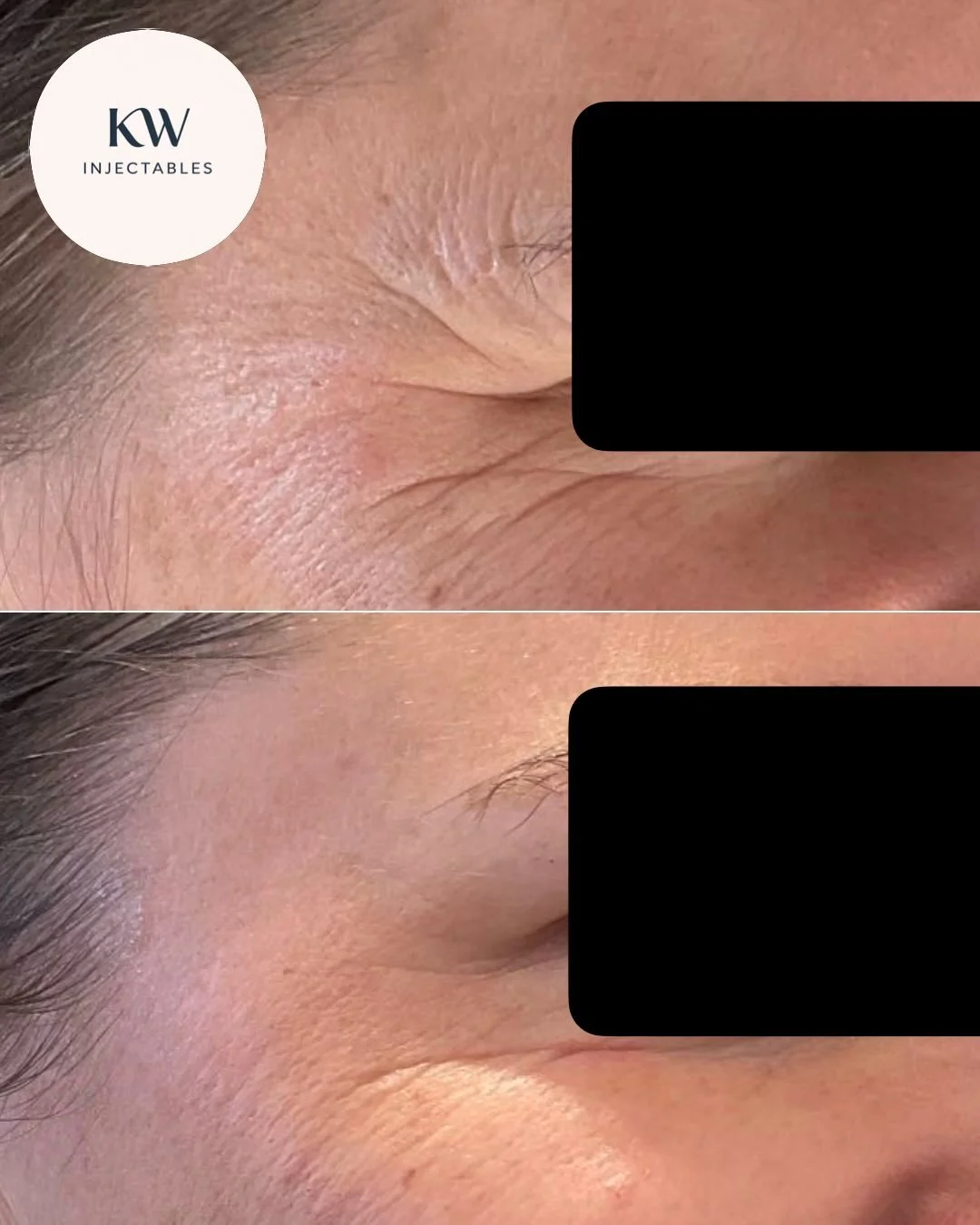 Before and after Dysport&reg; treatment to my client&rsquo;s lateral canthal lines (aka crows feet). 

Natural, and not overdone ✨

🌸 Thinking about antiwrinkle or have questions? Book your complimentary consult via the link in my bio 🌸

&bull;
&bu
